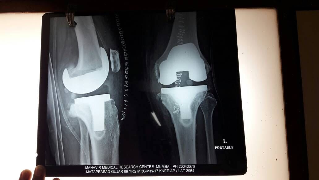 Dr. Vivek Allahbadia performing orthopaedic knee surgery in the operating theatre at Hinduja Healthcare Surgical, Khar