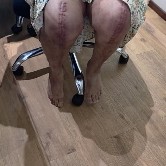 Bilateral knee replacement 3 months after cardiac stents