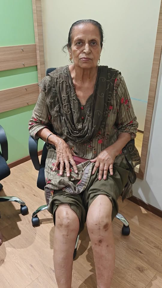 Mrs. Amarjeet Kaur Talwaar, 74, still pain-free 16 years after bilateral knee replacement